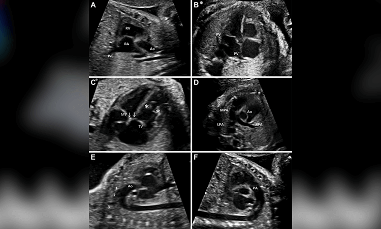 ecocardiografia fetal - ginecolgos en cucuta